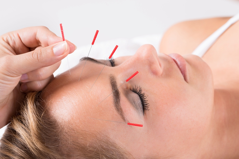 Marcas de acne, rugas e flacidez do rosto podem ser tratadas com a técnica milenar. A acupuntura estimula a produção de colágeno e elastina / GB Imagem 